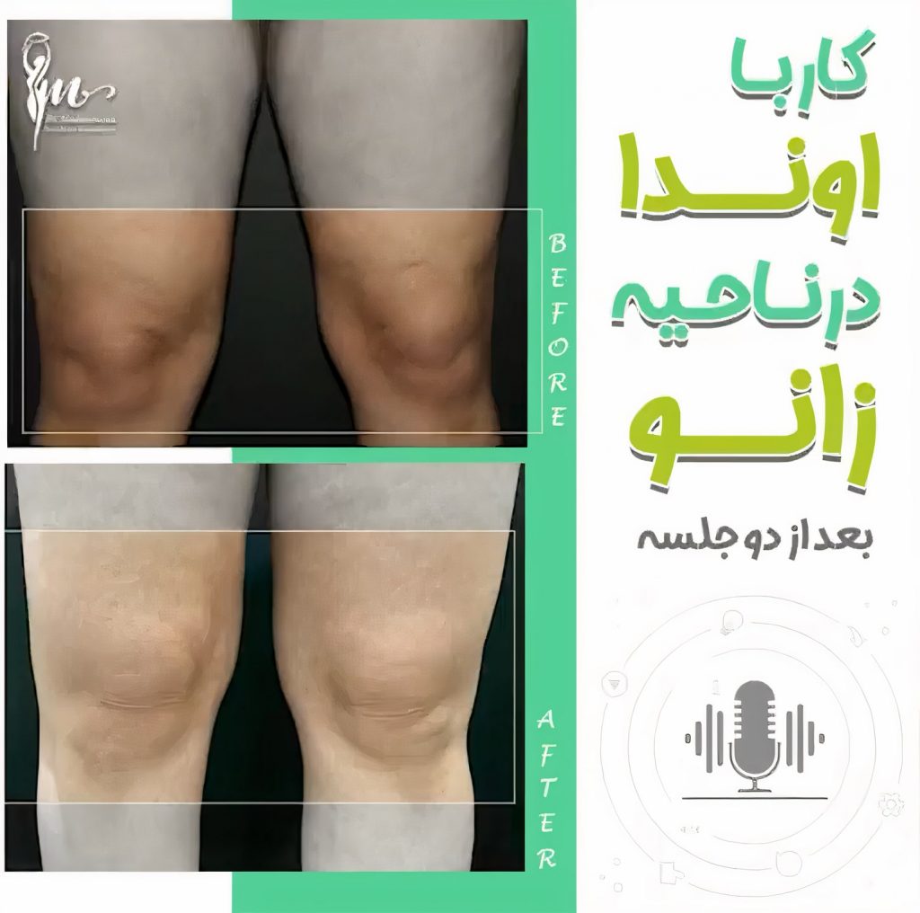 کار با اوندا در ناحیه زانو_