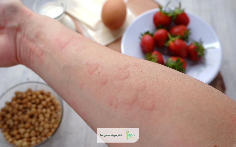 لیست غذاهای حساسیت زا برای انسان