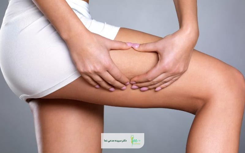 مقایسه دستگاه لاغری اوندا پرو و کویتیشن و کرایولیپولیز در کاهش سایز ران پا