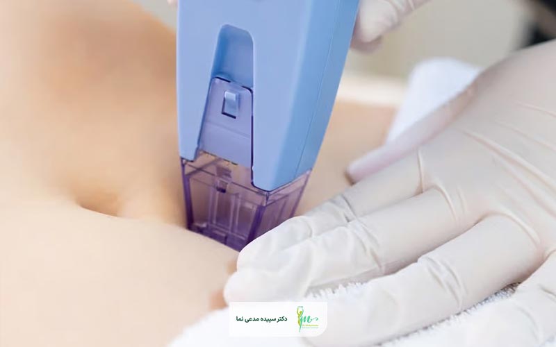درمان شلی پوست با دستگاه به چه معناست و چگونه انجام میشود؟