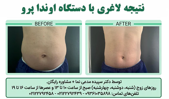 نتیجه لاغری با دستگاه اوندا پرو