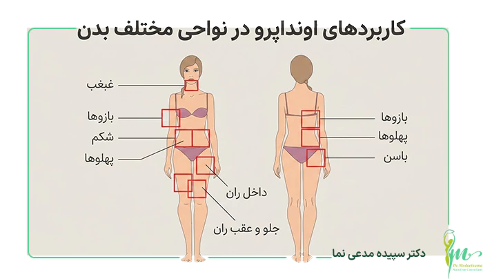 کاربرد های اوندا پرو در نواحی بدن