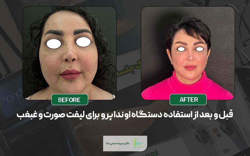 نمونه کار لاغری با دستگاه اوندا پرو توسط دکتر سپیده مدعی نما