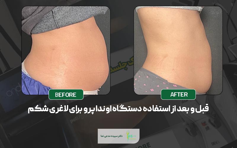 تصویر قبل و بعد از استفاده از دستگاه لاغری اوندا پرو