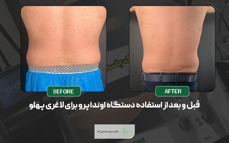 عکس قبل و بعد از لاغری با دستگاه اوندا پرو