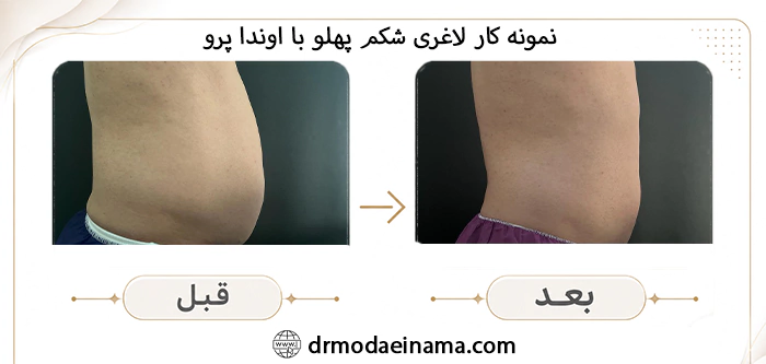 نمونه کار لاغری شکم پهلو با اوندا پرو
